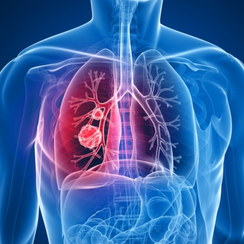 Un nou medicament anticancer reduce semnificativ riscurile în tratarea cancerului pulmonar