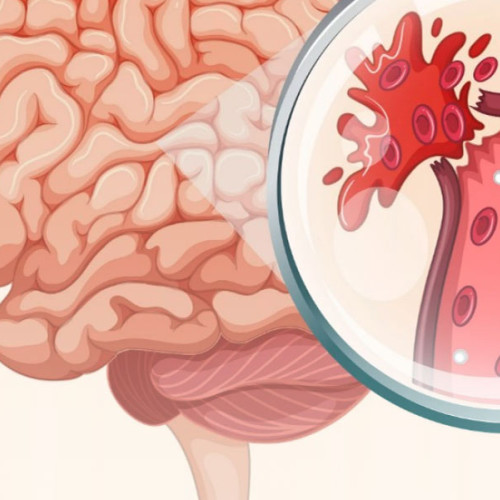 Cauzele accidentelor vasculare cerebrale: hipertensiunea arterială, poluarea și fumatul