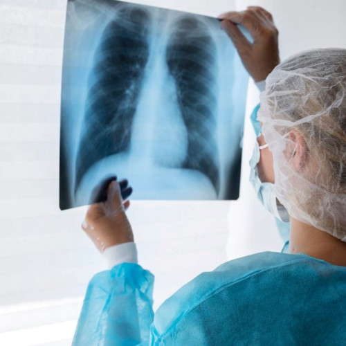 Cancerul pulmonar: Cauze, simptome și riscuri