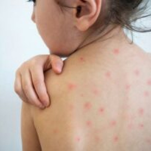 MICA VICTIMĂ DE RUJEOLĂ ÎN BRAȘOV / Aproape 9.000 de cazuri confirmate de rujeolă în întreaga țară
