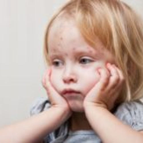 14.879 de cazuri de rujeolă confirmate în România, 15 decese înregistrate de la începutul anului 2023